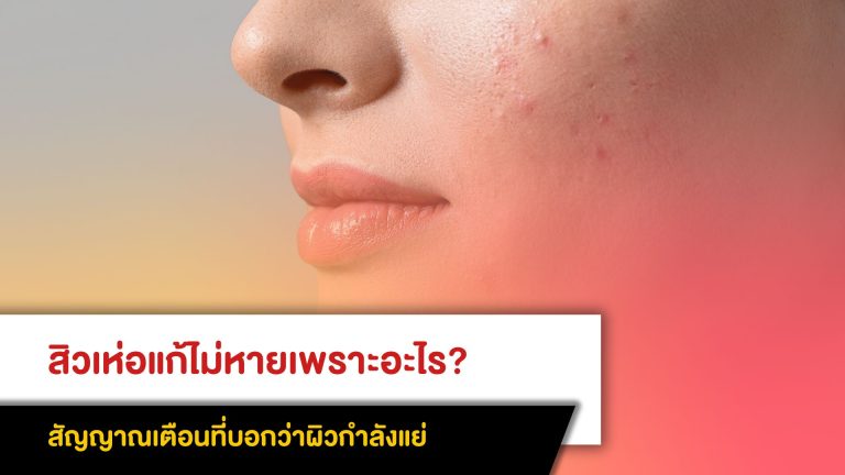สิวเห่อแก้ไม่หายเพราะอะไร? สัญญาณเตือนที่บอกว่าผิวกำลังแย่